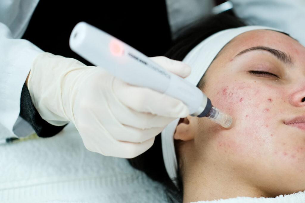 Closeup view of woman having microneedling procedure applied on her face